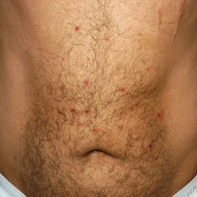 Choroba Behçeta objawy skórne