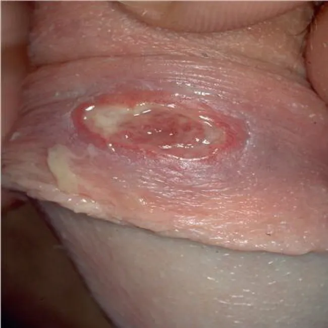 Choroba Behçeta wrzód na genitaliach