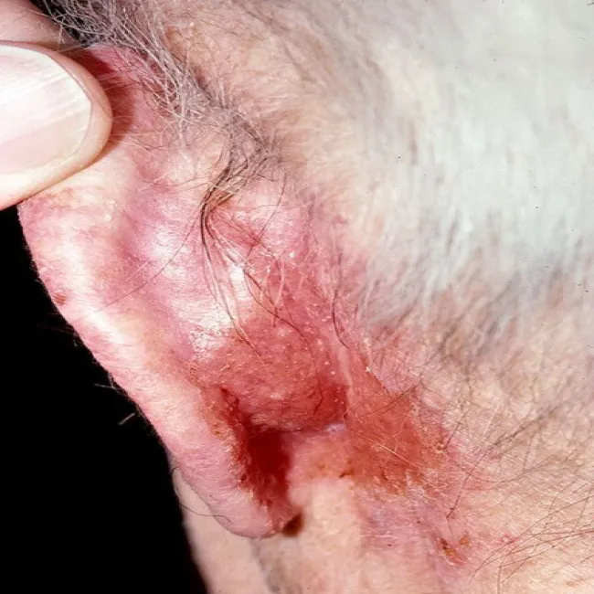 Choroba Bowena na głowie