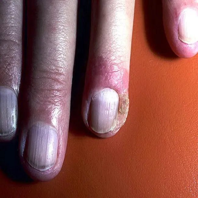 Choroba Bowena na paznokciu