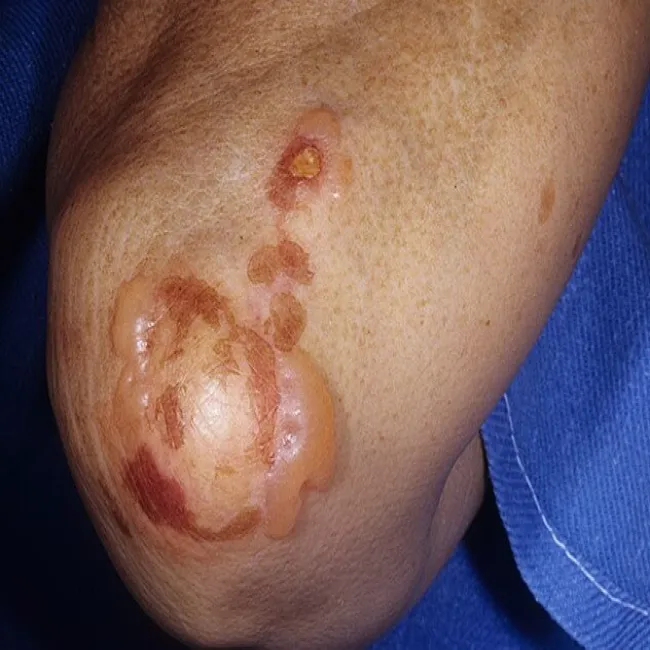 Choroba Duhringa objawy pęcherze i pęcherzyki