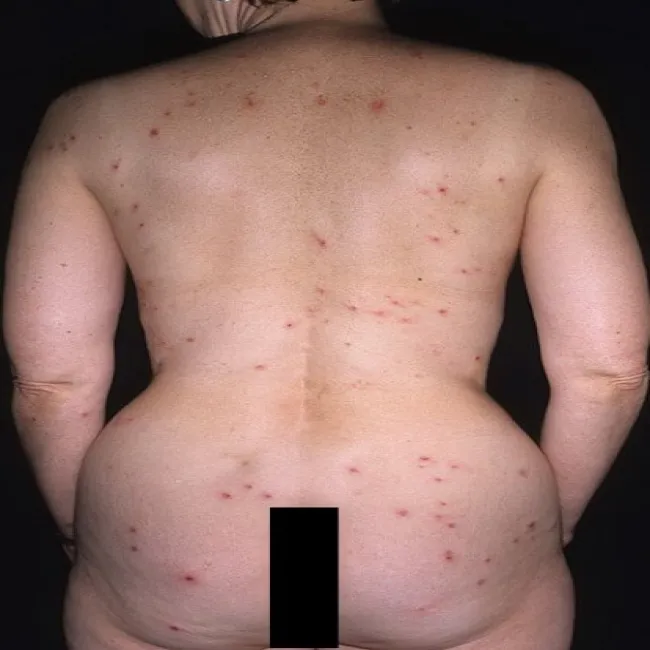 Choroba Duhringa wysypka na ciele zdjęcia