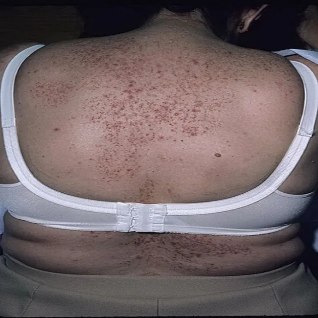 Choroba Grovera u kobiet