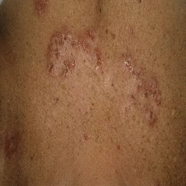 Choroba Haileya-Haileya na skórze