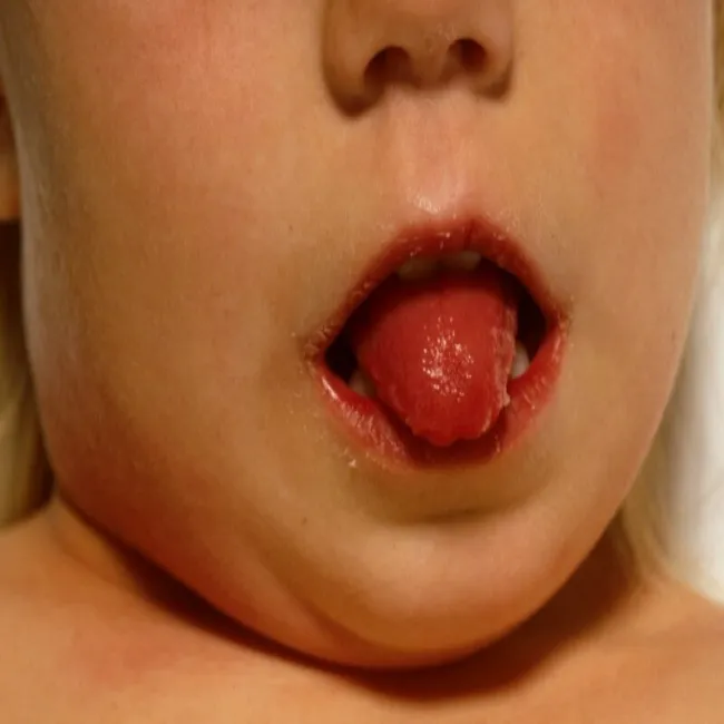 Choroba Kawasaki objaw na języku