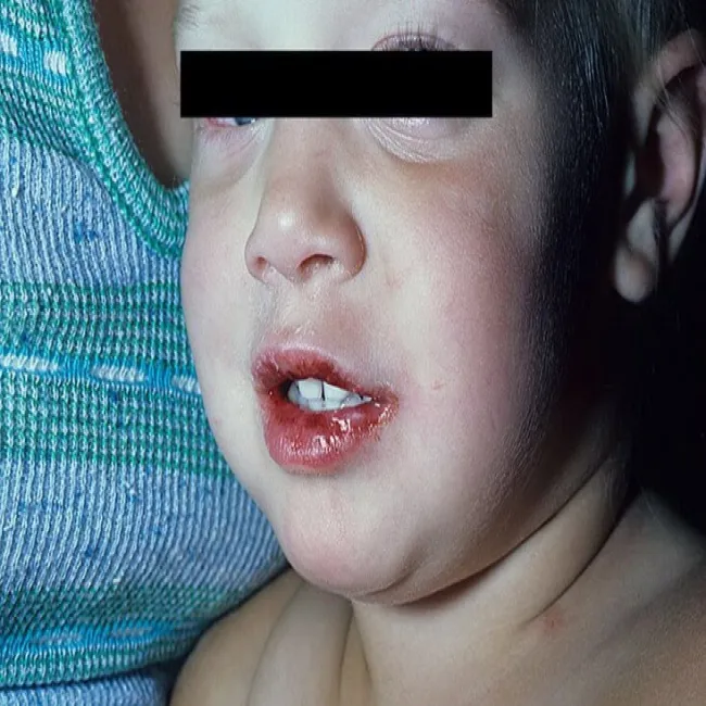 Choroba Kawasaki u dzieci