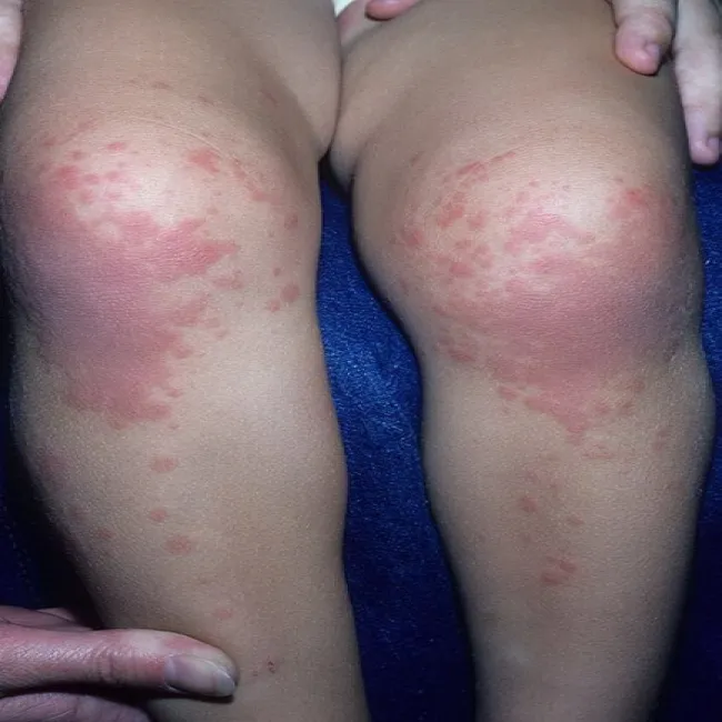 Choroba Kawasakiego objawy skórne