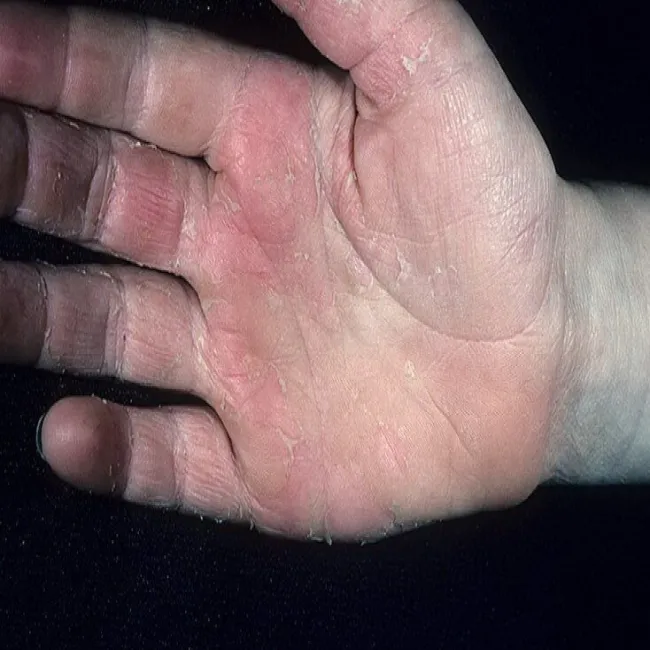 Choroba Kawasakiego u dorosłych 