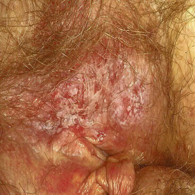 Choroba Pageta pozasutkowa