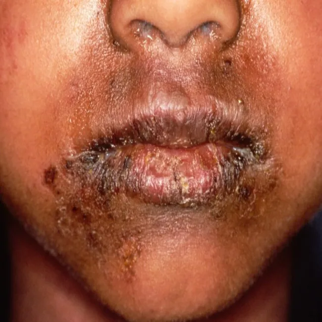 Choroba Rittera u dzieci