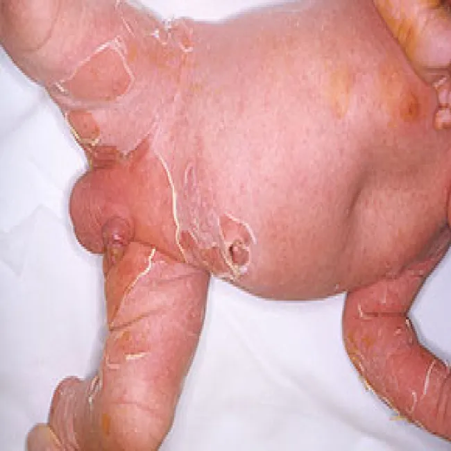 Choroba Rittera u niemowląt objawy