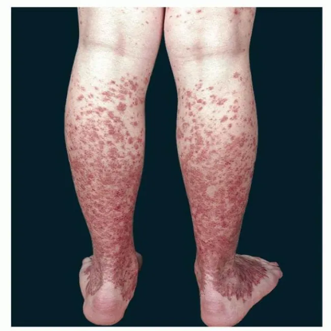 Choroba Schamberga na nogach