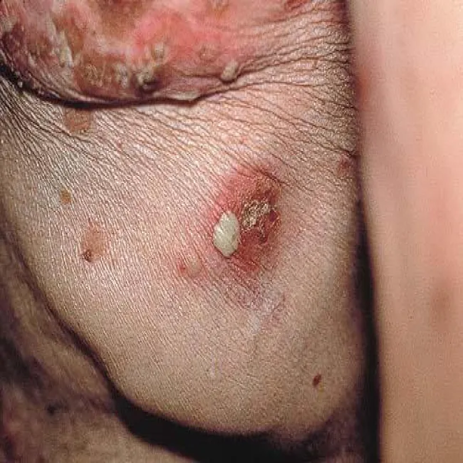 Choroba Sneddona - Wilkinsona objawy