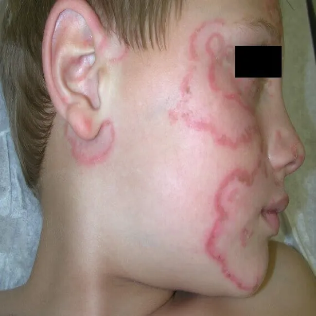 Choroba Sneddona - Wilkinsona u dziecka