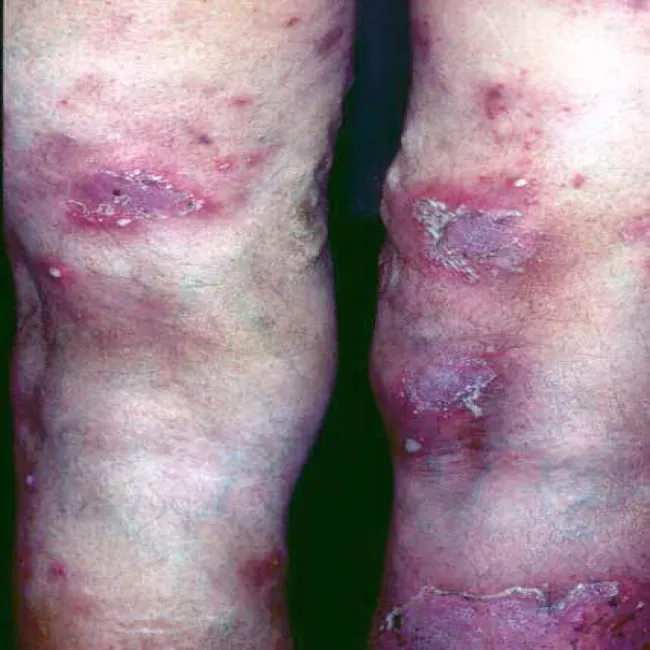 Choroba Sneddona - Wilkinsona zdjęcie