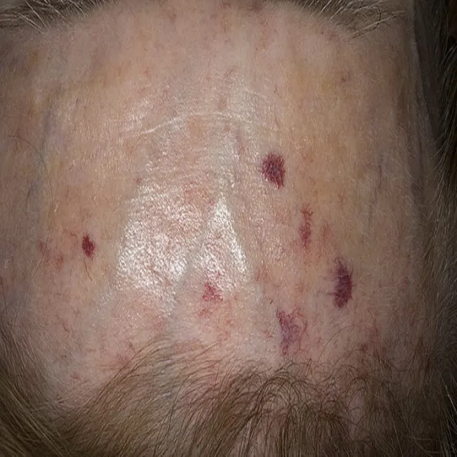Choroba autoimmunologiczna zespół Thibierge`a-Weissenbacha