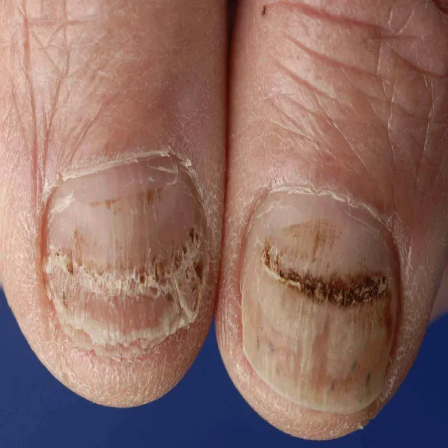 Choroba linie beau na paznokciach
