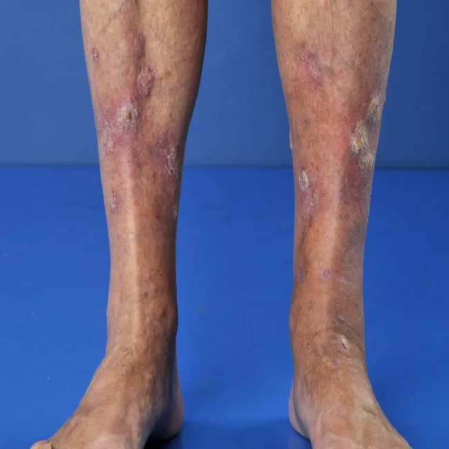 Choroba liszaj płaski na nogach