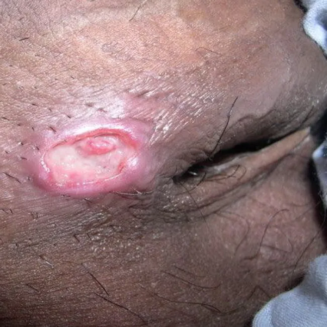 Choroba przenoszona drogą płciową ziarniniak pachwinowy 