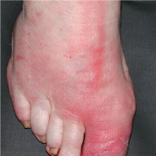 Choroba róża na stopie