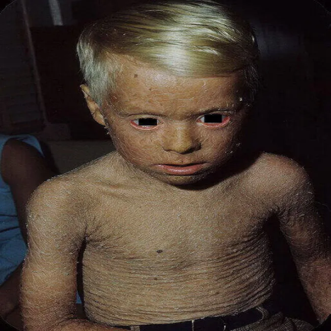 Choroba skórna rybia łuska u dziecka zdjęcie