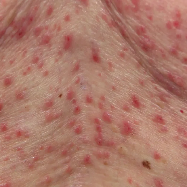 Choroba skóry choroba Grovera