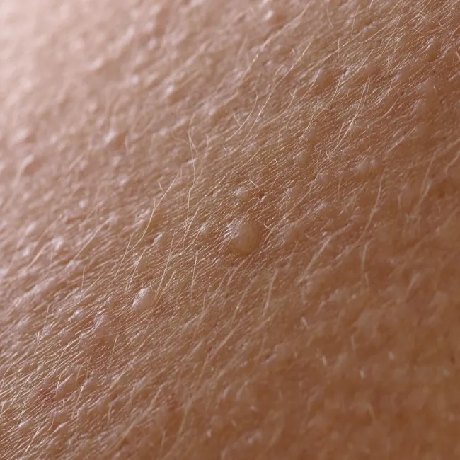 Choroba skóry liszaj lśniący 