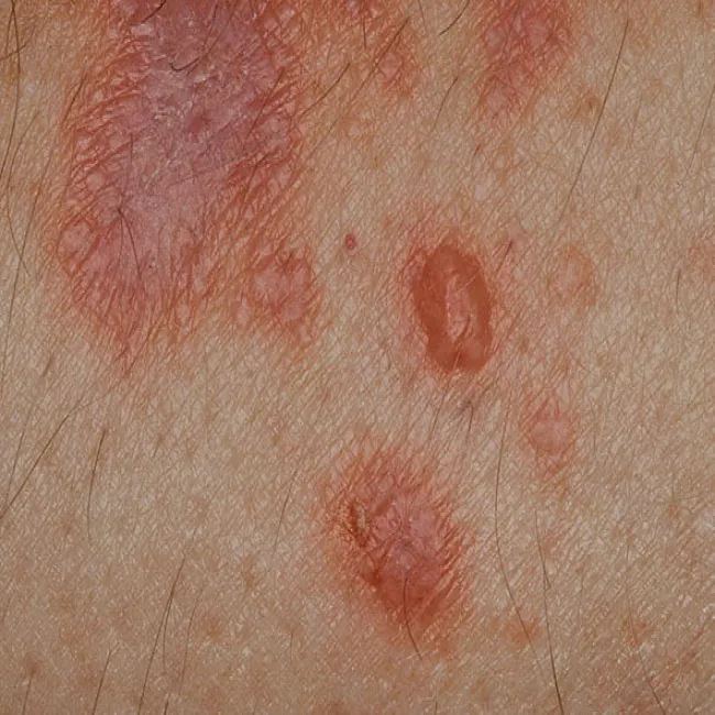 Choroba skóry pęcherzowy liszaj płaski