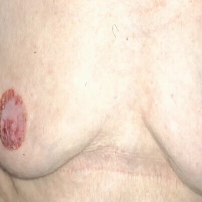 Choroba sutka rak Pageta