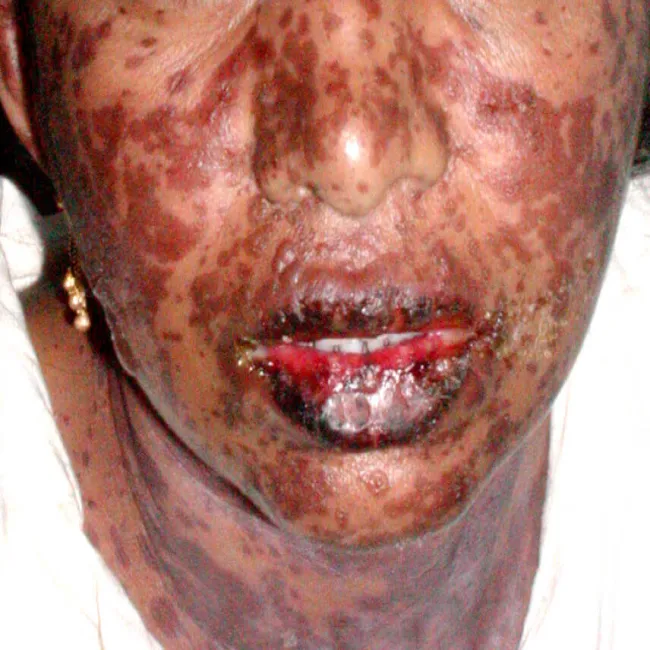 Choroba toksyczna nekroliza naskórka