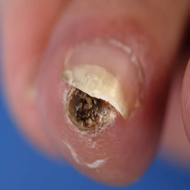 Choroba tropikalna tungiaza