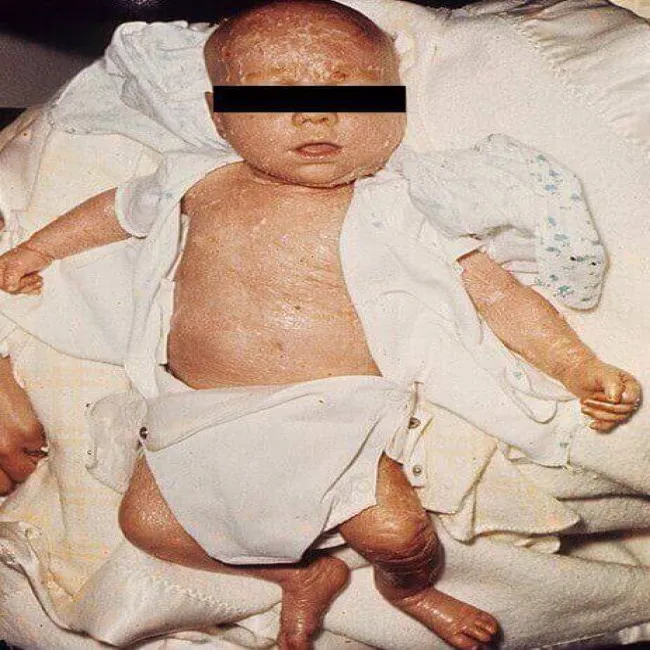 Choroba u noworodka rybia łuska wrodzona