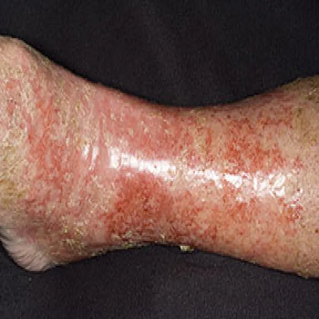 Choroba wyprysk żylakowy