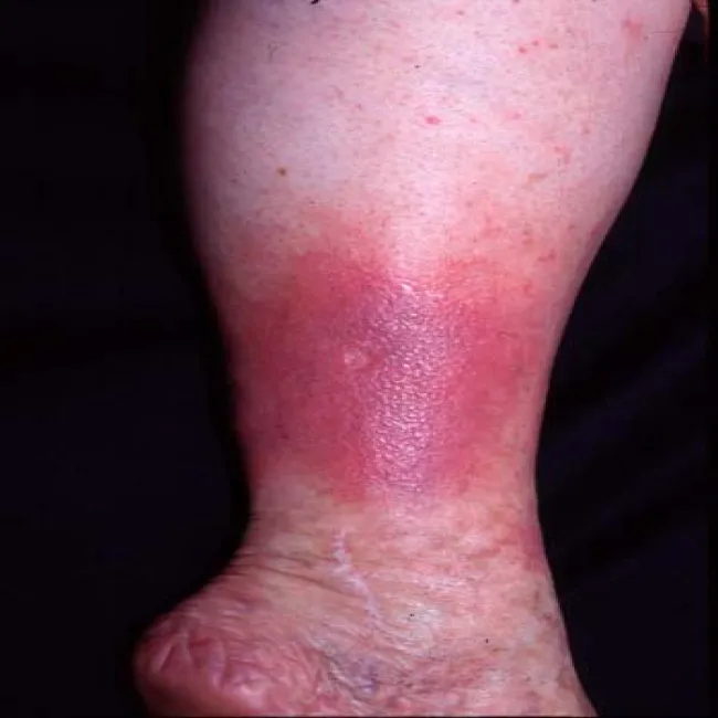 Choroba wyprysk podudzi 