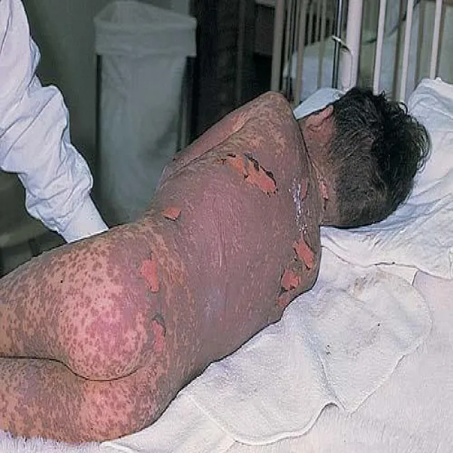 Choroba zespół Lyella u dzieci