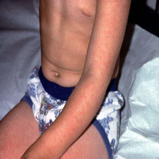 Choroba zakaźna u dzieci 