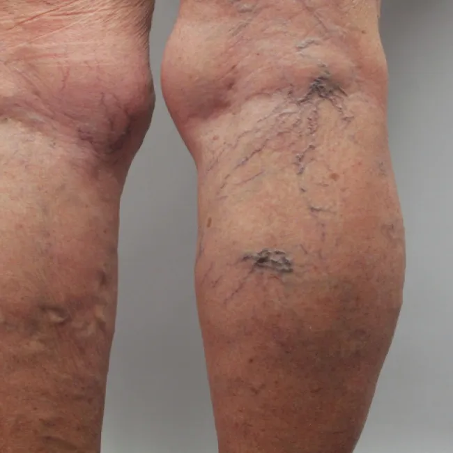 Choroby żylaki zdjęcia