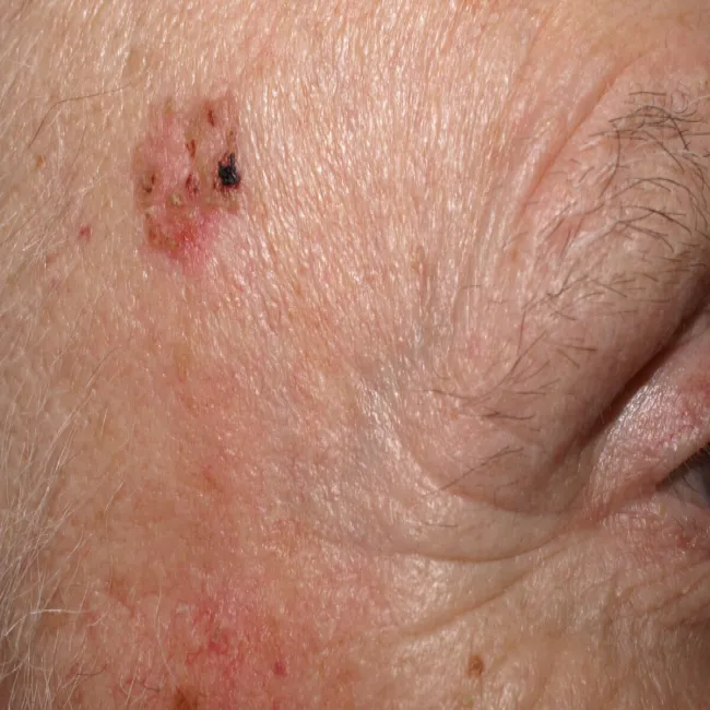 Choroby Bowena rak kolczystokomórkowy na twarzy