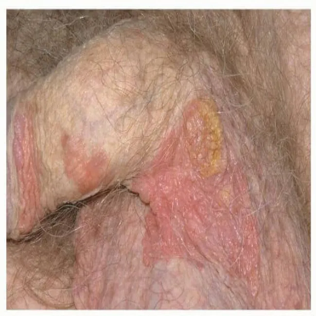 Choroby Bowena u mężczyzn okolice intymne