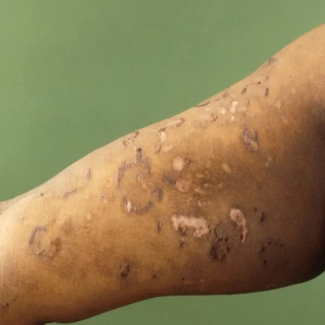 Choroby Duhringa zmiany na skórze o różnych rozmiarach i kształtach