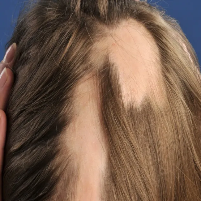 Choroby autoimmunologiczne łysienie plackowate