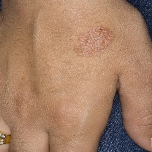 Choroby dłoni wyprysk pieniążkowaty 