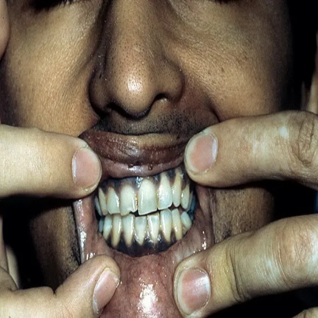 Choroby dziąseł choroba Addisona