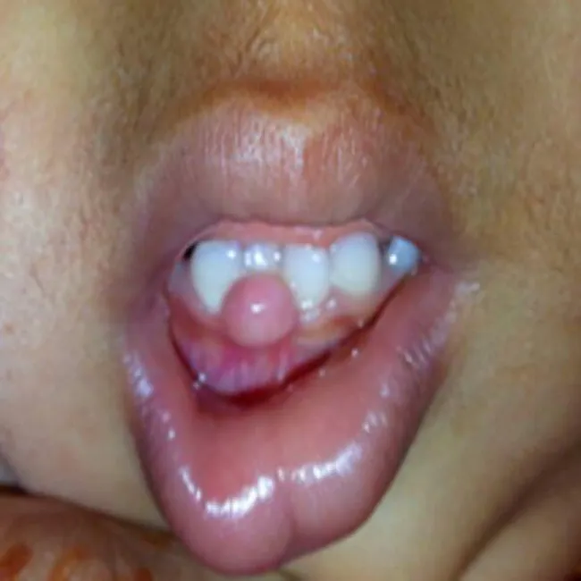 Choroby dziąseł u dzieci nadziąślak 