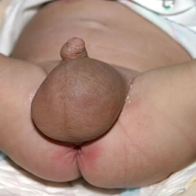 Choroby jąder u dzieci wodniak jądra 