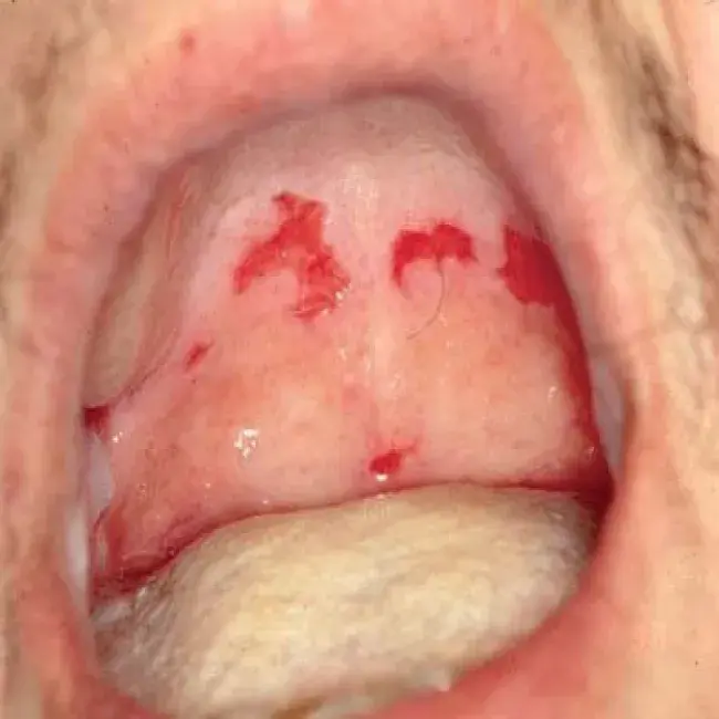 Choroby jamy ustnej pęcherzyca zwykła