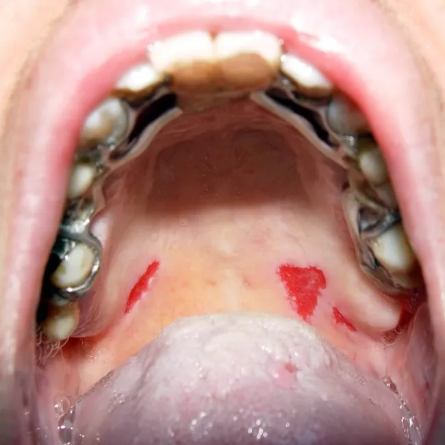 Choroby jamy ustnej pęcherzyca zwykła