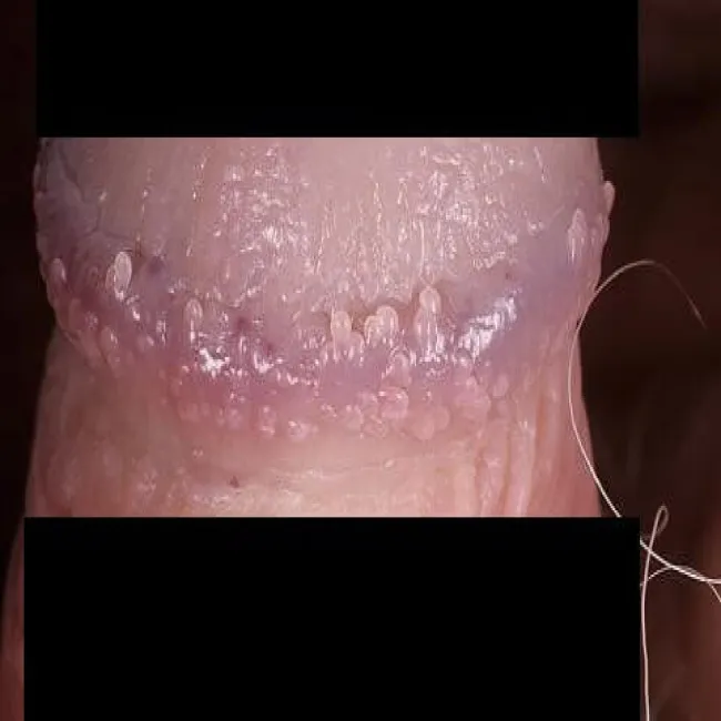 Choroby męskie grudki perliste