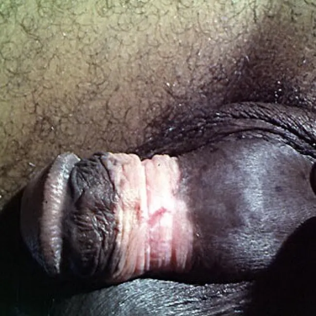 Choroby napletka obrazy zapalenie napletka