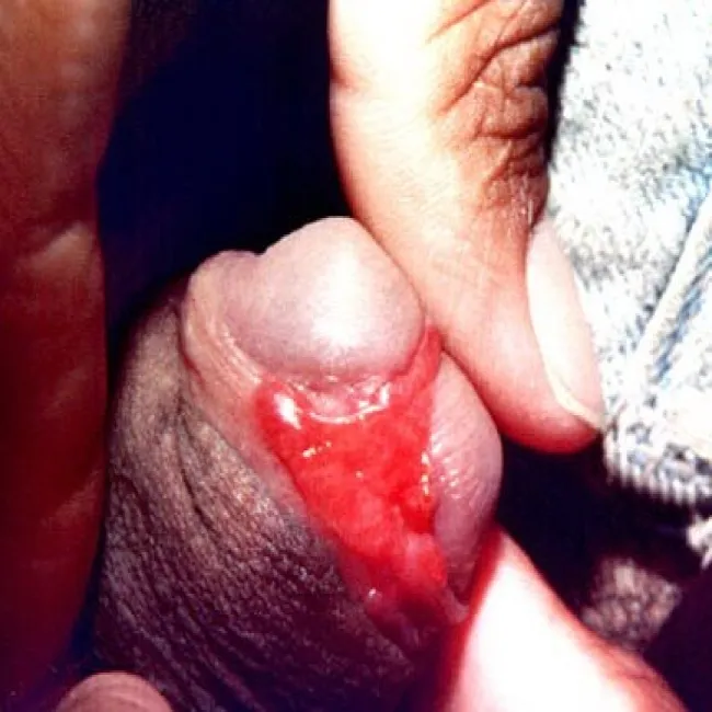 Choroby opis zdjęcia prącia ziarniniak pachwinowy 